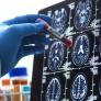 Análisis de sangre para detectar alzheimer: qué pueden detectar y cuánta fiabilidad tienen, según los expertos