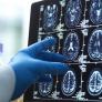 Investigadores británicos identifican seis síntomas depresivos en la mediana edad que aumentan hasta un 50% el riesgo de demencia