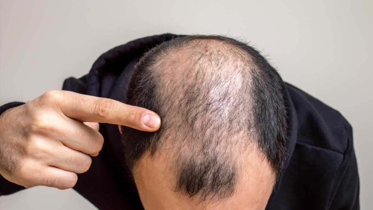 Cómo identificar los primeros síntomas de la alopecia