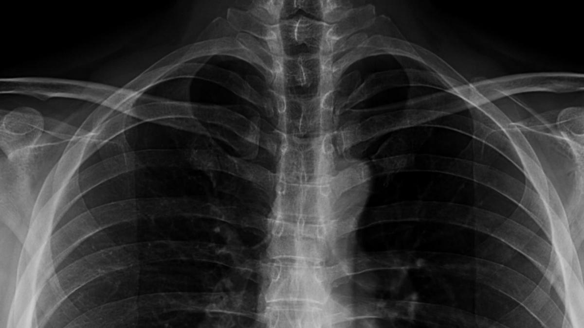 "Sentía cómo se movía entre mis costillas": acaba en urgencias tras tragarse una cuchara de 17 centímetros entera