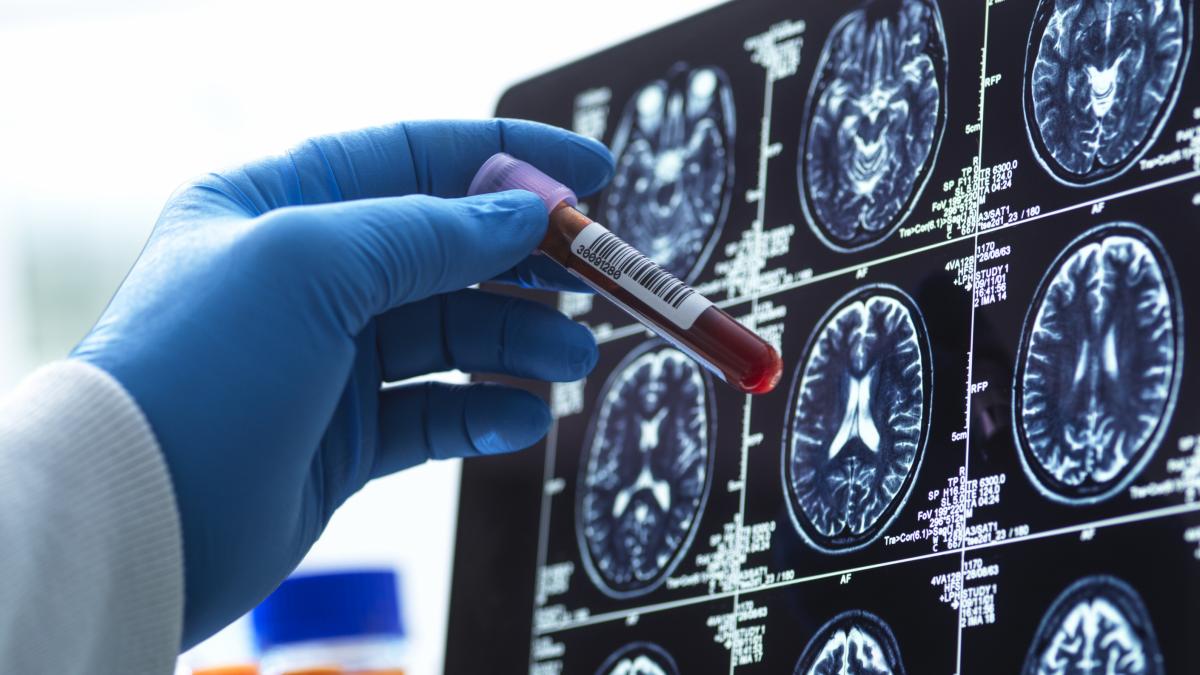Análisis de sangre para detectar alzheimer: qué pueden detectar y cuánta fiabilidad tienen, según los expertos