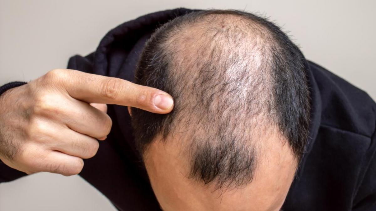 España es el país con mayor porcentaje de hombres calvos del mundo