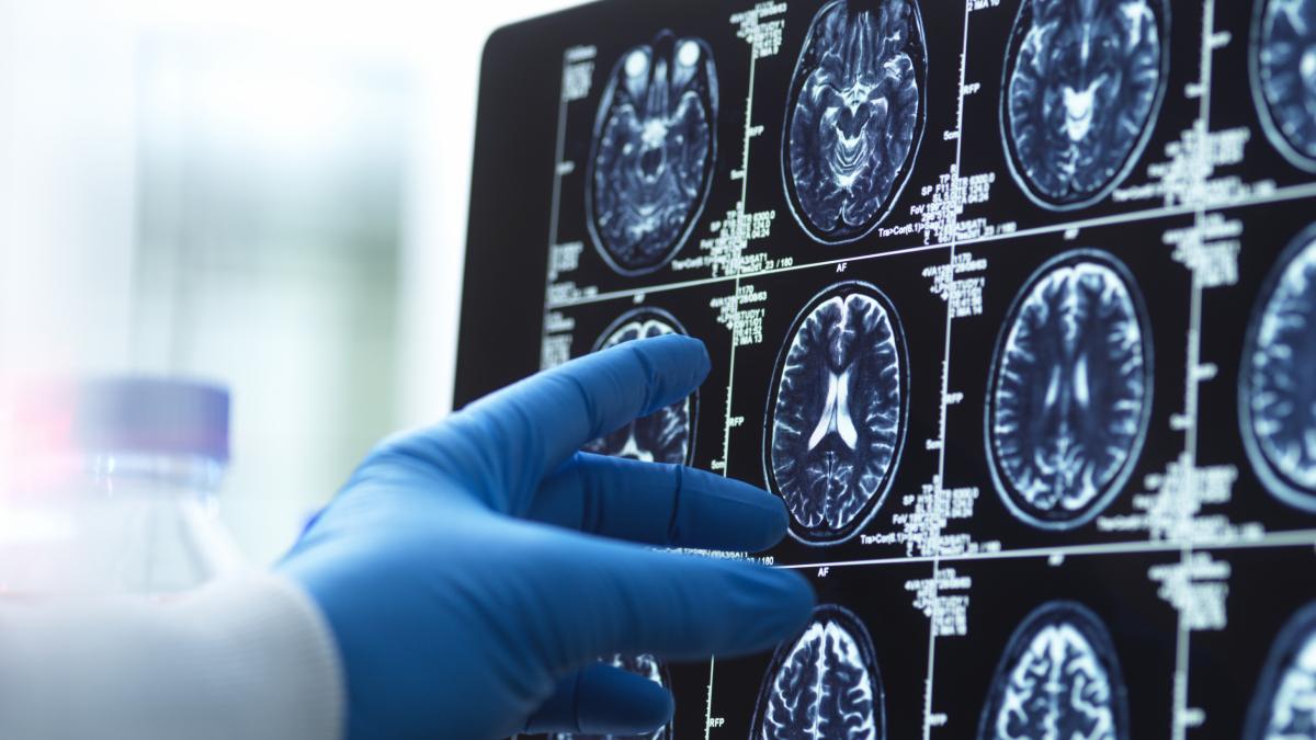 Investigadores británicos identifican seis síntomas depresivos en la mediana edad que aumentan hasta un 50% el riesgo de demencia
