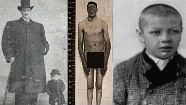 El curioso caso de Adam Rainer, el único humano en padecer enanismo y ...