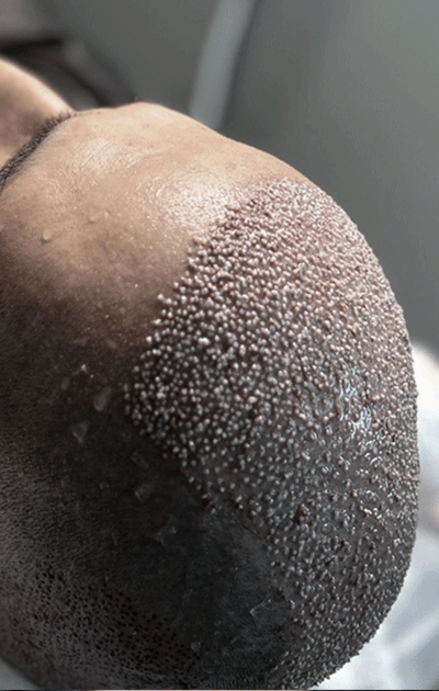 Después del procedimiento, el cuero cabelludo estará sensible.