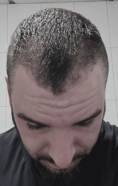 El nuevo crecimiento de cabello comenzará siendo lento.