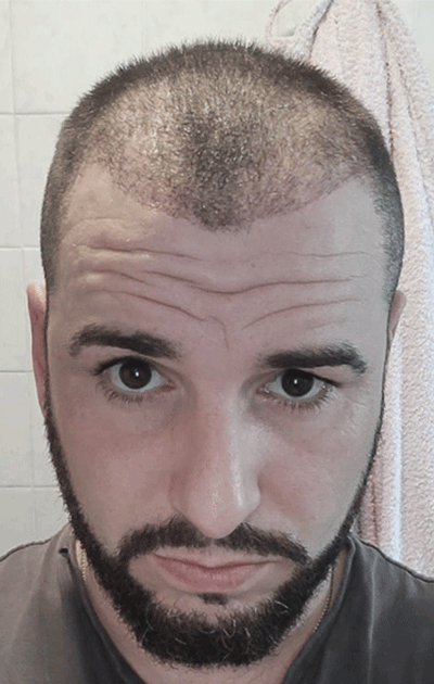 La fase de caída, conocida como "pérdida por shock", es completamente normal